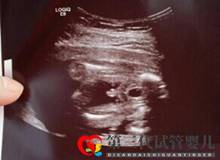 求錦鯉、望翻盤，想生男孩的她們有多努力？(圖1)