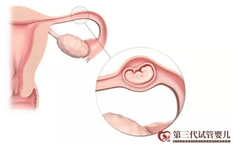 做試管嬰兒是不是可以避免宮外孕了？醫生告訴你沒那么簡單！(圖1)