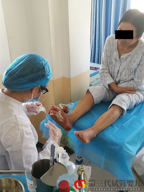 糖尿病并發癥糖尿病足到底有多可怕,可以避免截肢嗎?(圖2) 糖尿病并發癥糖尿病足到底有多可怕,可以避免截肢嗎?(圖2)