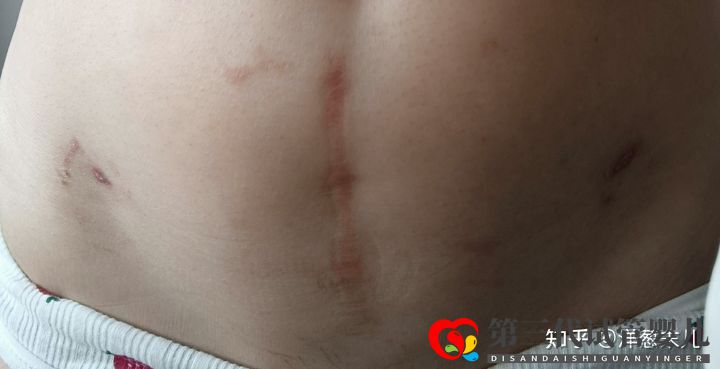 巧囊?腺肌癥?染色體異位試管路程(圖2) 巧囊?腺肌癥?染色體異位試管路程(圖2)