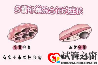 多囊做試管嬰兒要注意什么(圖2) 多囊做試管嬰兒要注意什么(圖2)