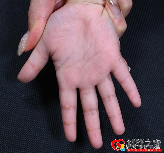 國際首次命名這種“罕見遺傳病”!源自廣東這支醫生團隊(圖2)