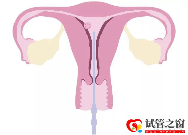 三代試管的真相,80%的人都不知道!學姐說(圖5)
