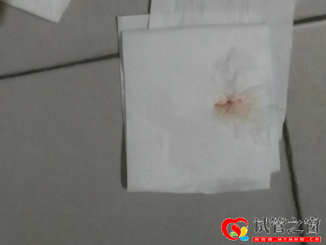 典型受精卵成功著床褐色分泌物圖片,別與月經(jīng)混為一談(圖1) 受精卵成功會(huì)少量出血