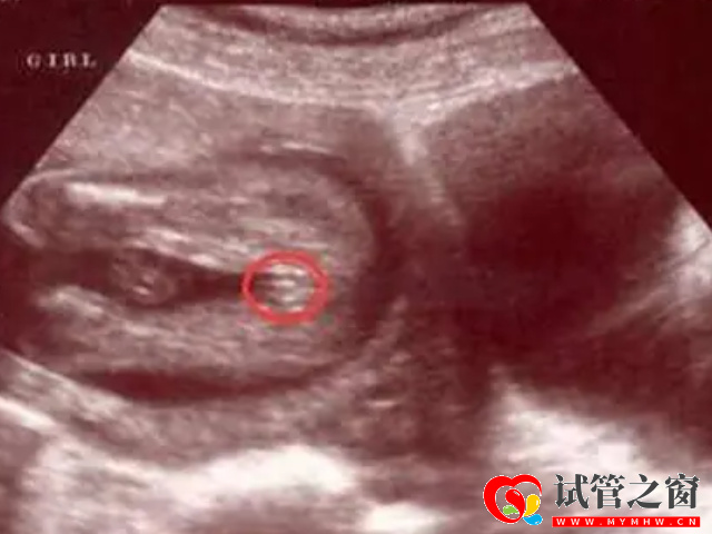 四維彩超懷女孩的特征