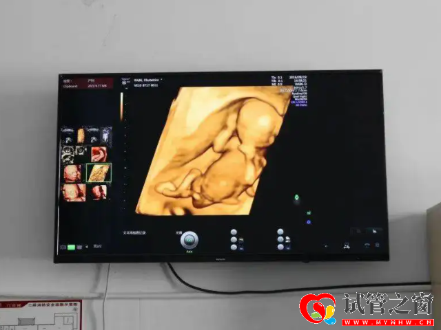 四維彩超胎兒面相清秀是男孩