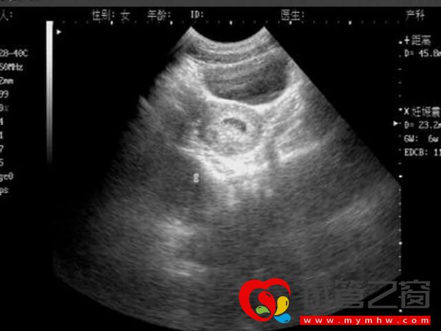 試管懷孕易出現胎盤低置