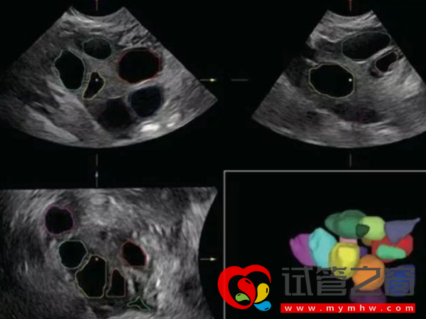 B超查空卵泡準確率并不高!如何能查出方法有三種(圖1) B超不能查出空卵泡