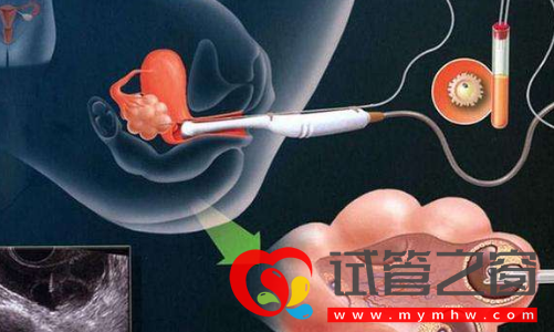 試管取卵手術示意圖