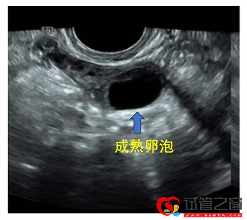 詳解B超監測排卵的那些事，助你交好“孕”(圖1)