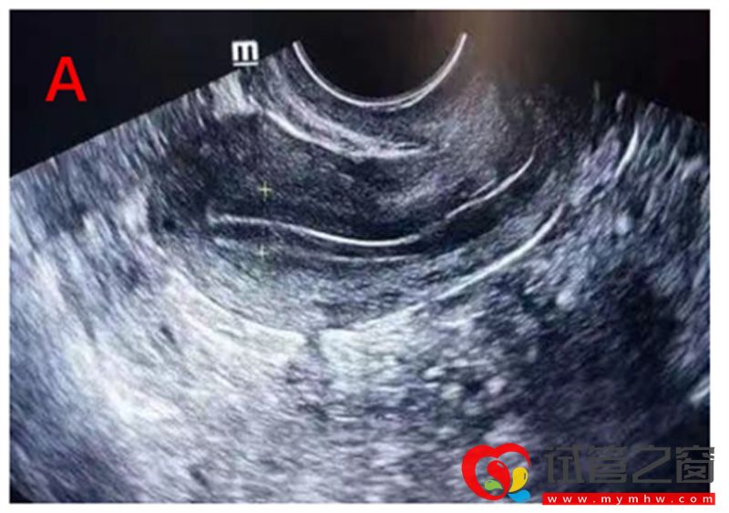 詳解B超監測排卵的那些事，助你交好“孕”(圖2)