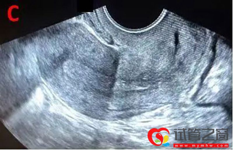 詳解B超監測排卵的那些事，助你交好“孕”(圖4)