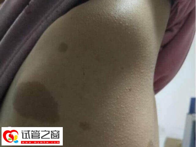 神經纖維瘤可能會影響卵子質量