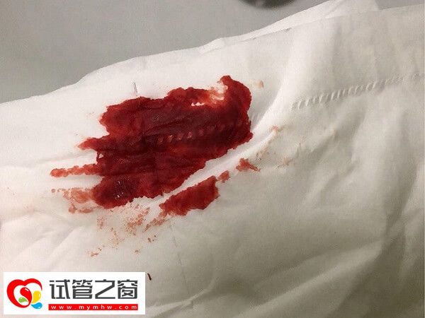 鮮胚移植后出血是不是胚胎著床失敗了