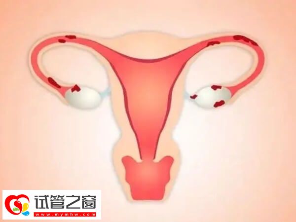 巧克力囊腫會影響宮腔環(huán)境