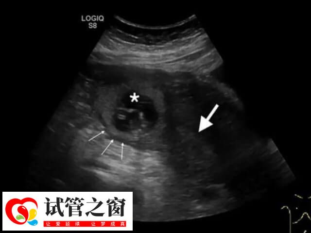 試管移植在子宮什么位置好(圖1) 胚胎一般移植在子宮的中部