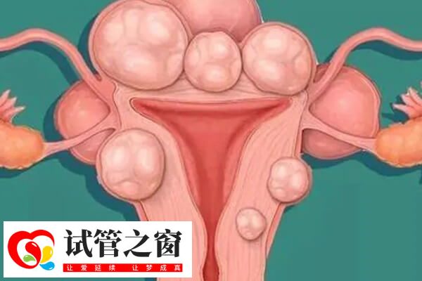 子宮肌瘤對試管嬰兒的影響有哪些(圖2) 子宮肌瘤試管前可以進行治療