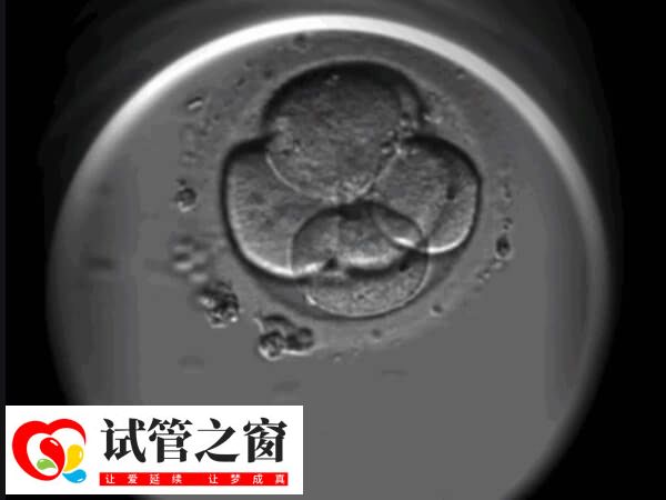 影響試管雙胎概率的因素多