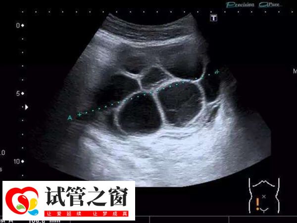 取卵過度會造成卵巢過度刺激癥