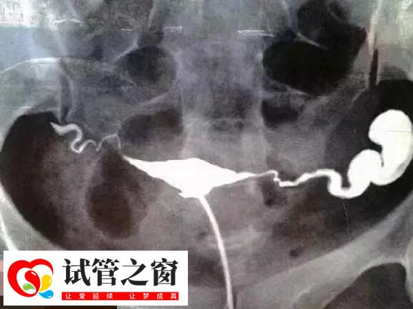 輸卵管積水含微生物碎屑等有害物質多