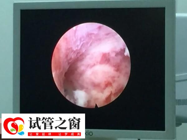 宮腔鏡可以確診宮腔疾病