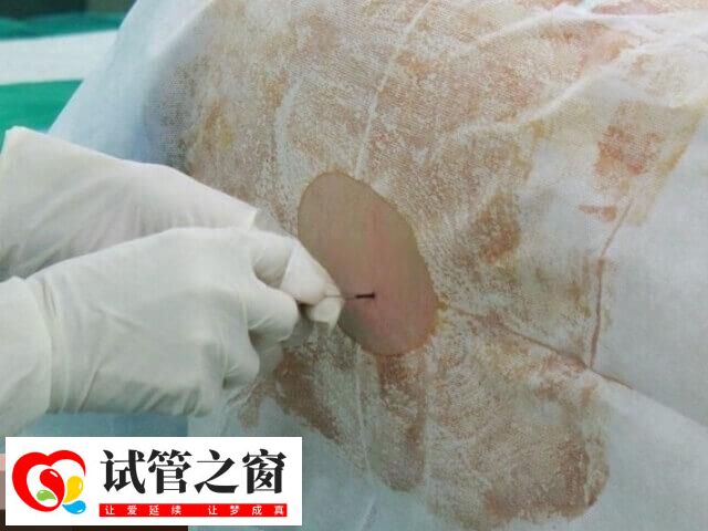 宮腔鏡是一種微創(chuàng)性婦科診療技術(shù)