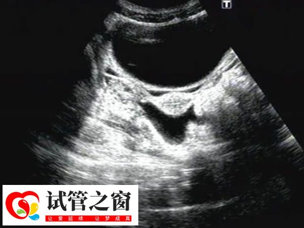 盆腔積液是女性生殖系統的常見癥狀表現