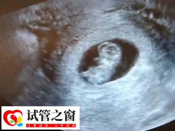 試管一超主要是看孕囊著床位置