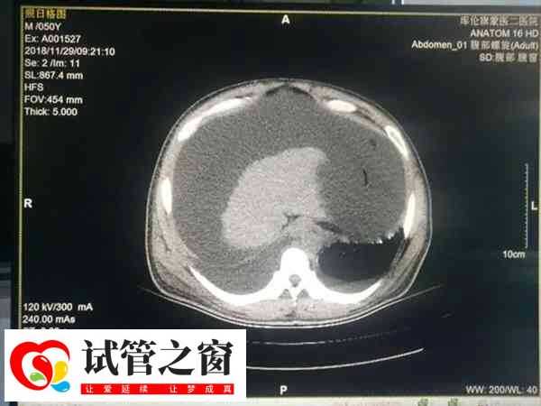 試管嬰兒是一種體外受精技術