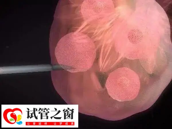 取卵前促排卵使用過多會增加患癌風險