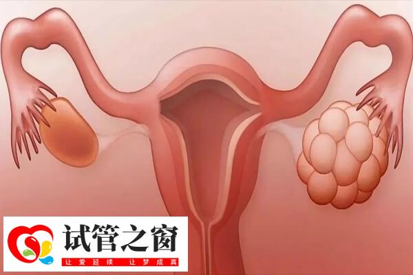 缺乏運動是多囊反復原因之一