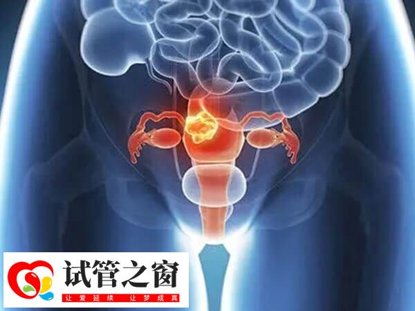 不當使用賀美奇會導致卵巢過度刺激