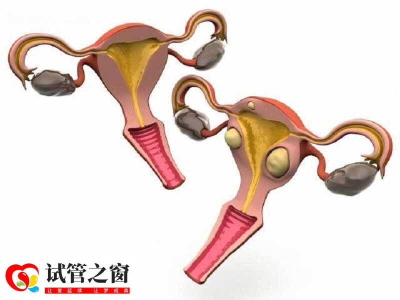 病理性卵巢囊腫不建議做試管嬰兒