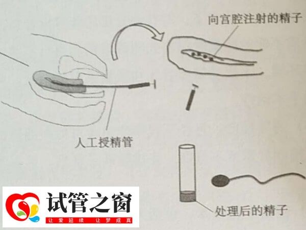 人工授精的成功率有多高?能達到20%嗎?(圖1) 人工授精成功率不高