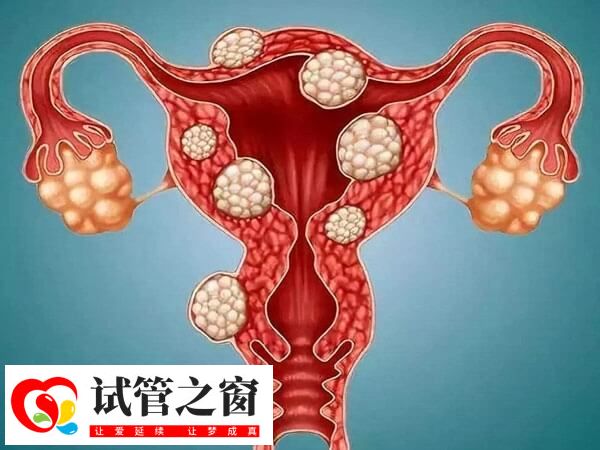 子宮肌瘤過(guò)大需要手術(shù)切除